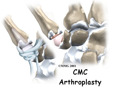 Artificial Joint Replacement of the Thumb - Family Physiotherapy's Guide