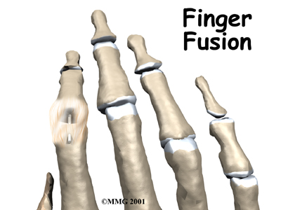 Finger Fusion Surgery - Family Physiotherapy's Guide