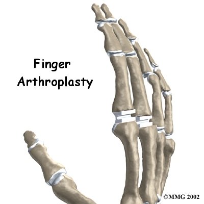 Artificial Joint Replacement of the Finger - Family Physiotherapy's Guide